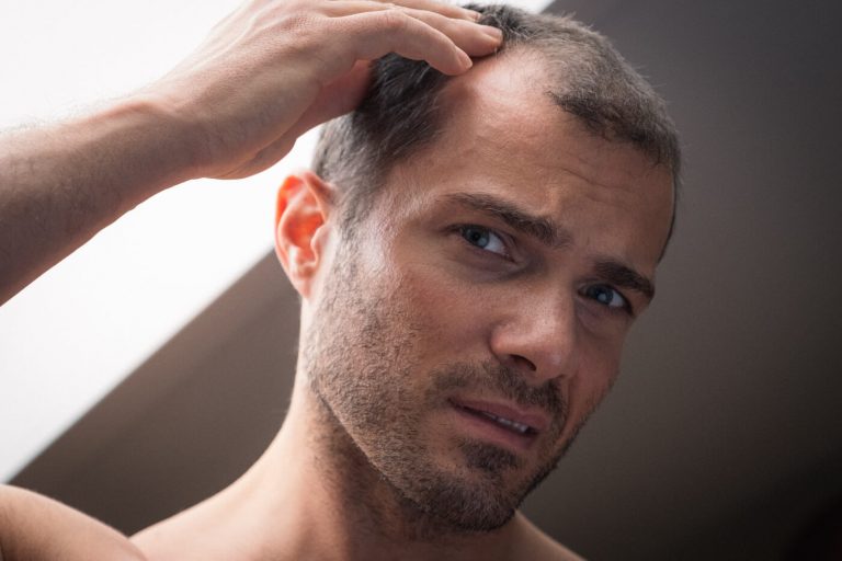 przeszczep włosów w Turcji koszty